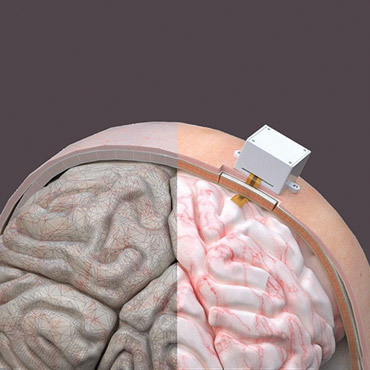 3D simulation of brain prosthesis before production